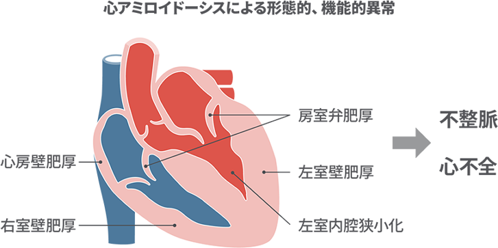 心アミロイドーシスによる形態的、機能的異常