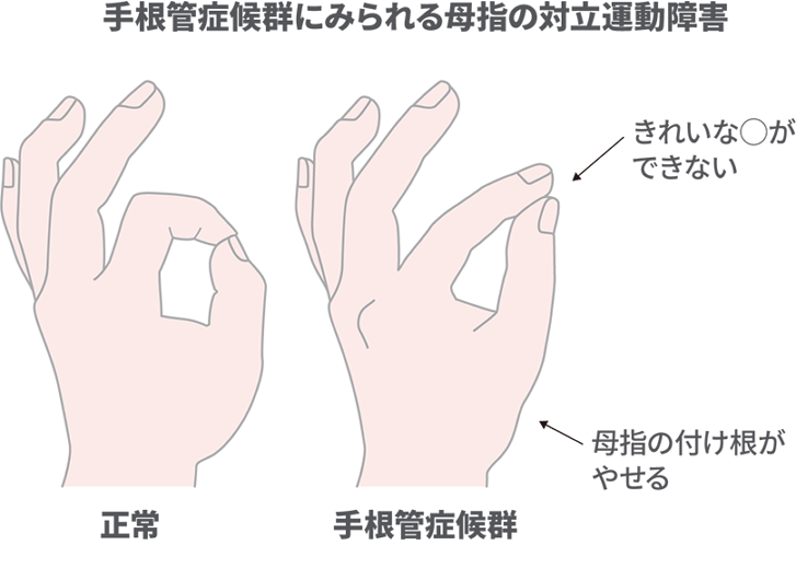 手根管症候群にみられる母指の対立運動障害