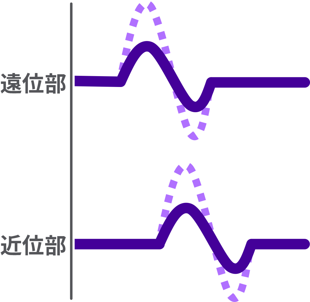 軸索変性がある場合の複合筋活動電位(CMAP)