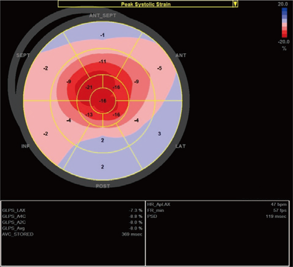 スペックルトラッキングによる左室長軸方向ストレインのBull’s eye 表示