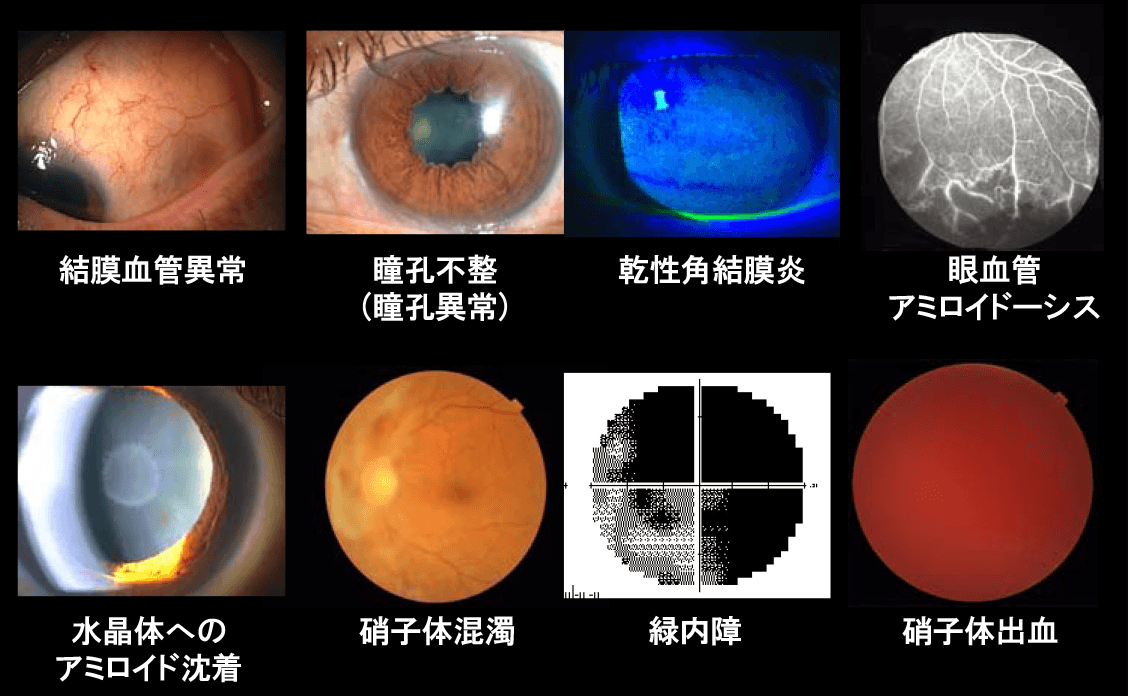 眼症候による長期的な合併症の例