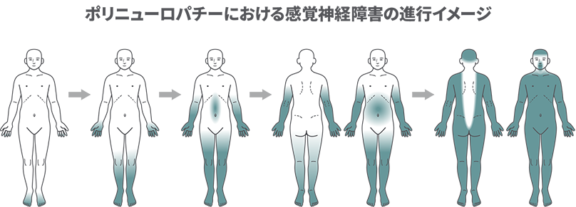 ポリニューロパチーにおける感覚神経障害の進行イメージ